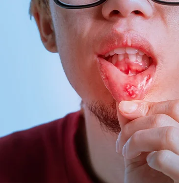 Oral Cancer: Myths vs. Facts – Early Detection and Prevention Tips